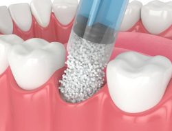 Bone Graft dalam Estetika Kedokteran Gigi, Menumbuhkan Kembali Kepercayaan Diri